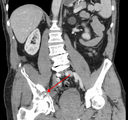 Esta é uma imagem de uma fratura de quadril em uma tomografia computadorizada.